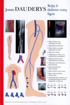 Kojų ir dubens venų ligos